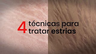 4 técnicas para tratar estrias [upl. by Nwahsat]