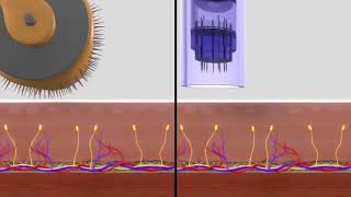 Dermapen v Dermaroller [upl. by Johnson]