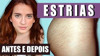 TCHAU ESTRIAS BRANCAS FUNCIONA Antes e Depois [upl. by Thisbe]