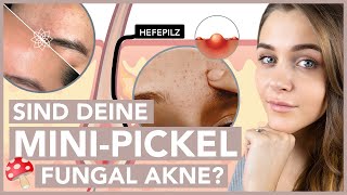 Pickel auf der Stirn – Das hilft bei FUNGAL AKNE [upl. by Aziram]