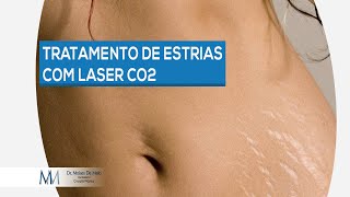 Dr Moises De Melo  Tratamento de estrias com Laser CO2 [upl. by Eddie]