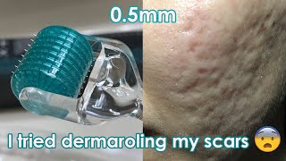 I tried dermarolling my ACNE SCARS  Demo  Review [upl. by Wanfried]