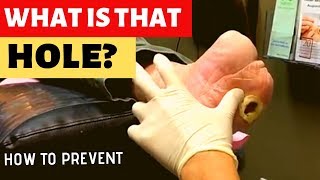 HOW WE TREAT DIABETIC WOUNDS [upl. by Matuag]