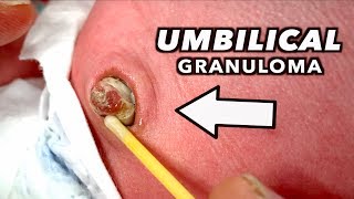 LARGE UMBILICAL GRANULOMA Cauterized with Silver Nitrate  Dr Paul [upl. by Aiclef70]