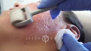 Dermaroller  Microneedling Acne Scars  Skin Resurfacing  Los Angeles California [upl. by Jolene]