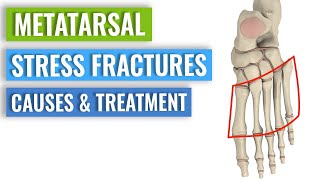 Metatarsal Stress Fractures  Causes Treatment Prevention [upl. by Onirefes]