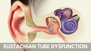 What is Eustachian Tube Dysfunction [upl. by Witha623]