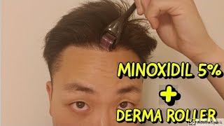 HOW TO USE DERMA ROLLER AND MINOXIDIL FOR HAIR GROWTH [upl. by Aicila]