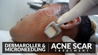 Microneedling for Acne Scars Treatment  Dermaroller Before and After  Skin Resurfacing  Dr Jason [upl. by Aihsenyt81]